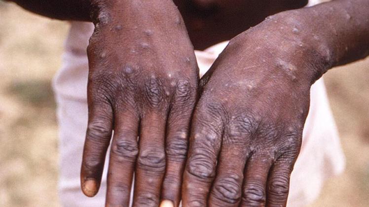 Le pustole lasciate dal mpox, detto vaiolo delle scimmie