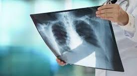 Una radiografia ai polmoni